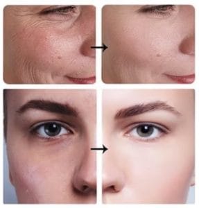 Avant apres masque led